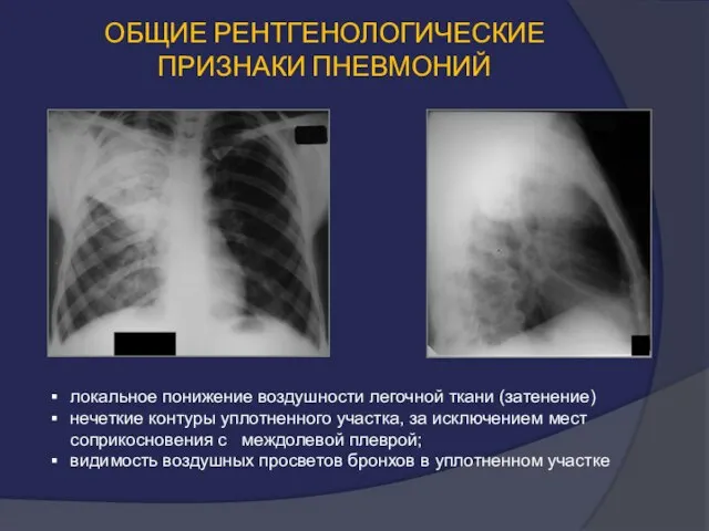 ОБЩИЕ РЕНТГЕНОЛОГИЧЕСКИЕ ПРИЗНАКИ ПНЕВМОНИЙ локальное понижение воздушности легочной ткани (затенение) нечеткие