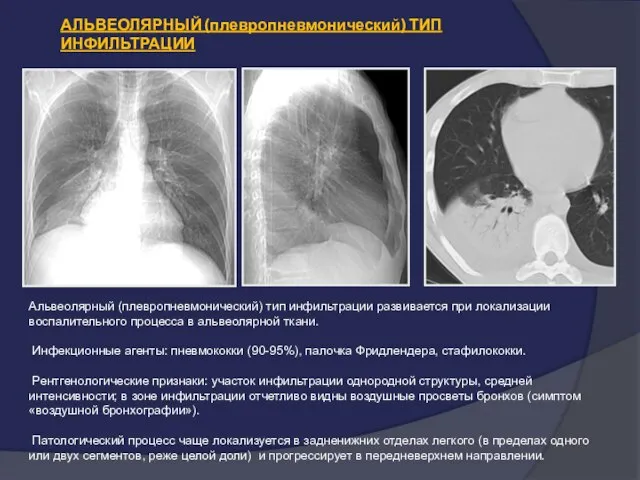 АЛЬВЕОЛЯРНЫЙ (плевропневмонический) ТИП ИНФИЛЬТРАЦИИ Альвеолярный (плевропневмонический) тип инфильтрации развивается при локализации