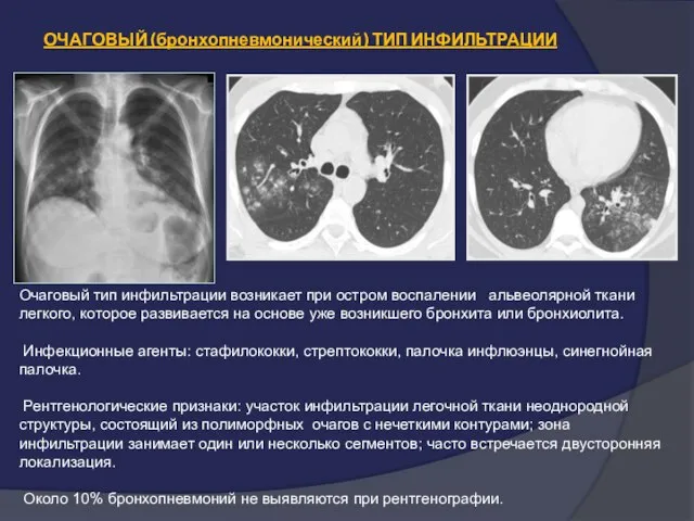 ОЧАГОВЫЙ (бронхопневмонический) ТИП ИНФИЛЬТРАЦИИ Очаговый тип инфильтрации возникает при остром воспалении