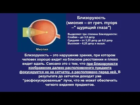 Близорукость (миопия – от греч. myops –" щурящий глаза") Близорукость –