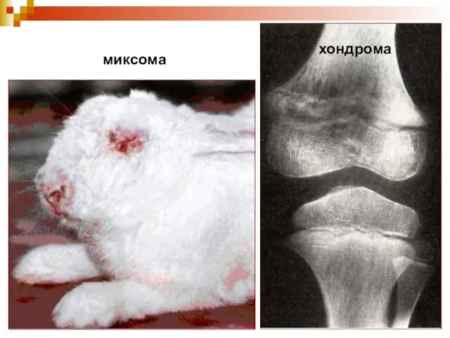 миксома хондрома