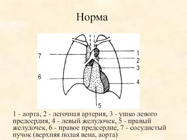 Норма 1 - аорта, 2 - легочная артерия, 3 - ушко