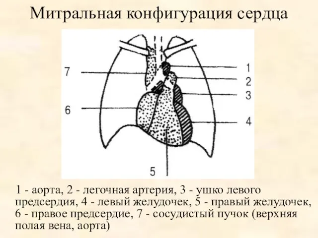 Митральная конфигурация сердца 1 - аорта, 2 - легочная артерия, 3