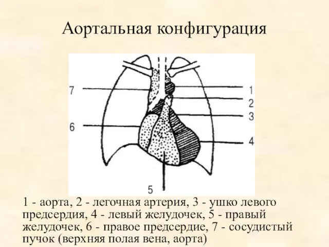 Аортальная конфигурация 1 - аорта, 2 - легочная артерия, 3 -