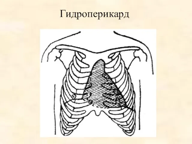 Гидроперикард