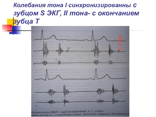 Колебания тона I синхронизированны с зубцом S ЭКГ, II тона- с окончанием зубца Т