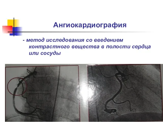 Ангиокардиография - метод исследования со введением контрастного вещества в полости сердца или сосуды