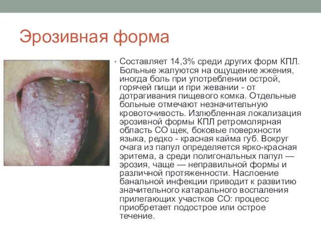 Эрозивная форма Составляет 14,3% среди других форм КПЛ. Больные жалуются на