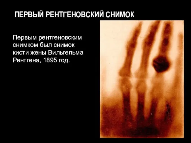 ПЕРВЫЙ РЕНТГЕНОВСКИЙ СНИМОК Первым рентгеновским снимком был снимок кисти жены Вильгельма Рентгена, 1895 год.