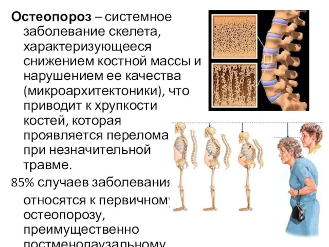 Остеопороз – системное заболевание скелета, характеризующееся снижением костной массы и нарушением