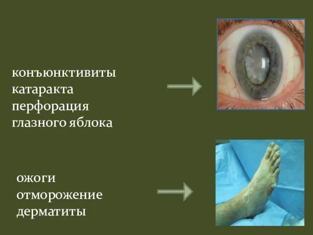 ожоги отморожение дерматиты конъюнктивиты катаракта перфорация глазного яблока