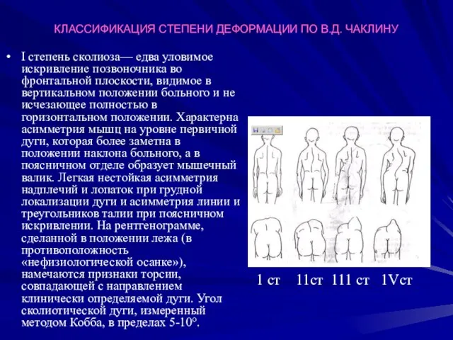 КЛАССИФИКАЦИЯ СТЕПЕНИ ДЕФОРМАЦИИ ПО В.Д. ЧАКЛИНУ I степень сколиоза— едва уловимое