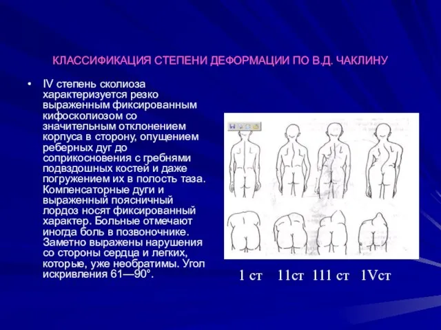 КЛАССИФИКАЦИЯ СТЕПЕНИ ДЕФОРМАЦИИ ПО В.Д. ЧАКЛИНУ IV степень сколиоза характеризуется резко