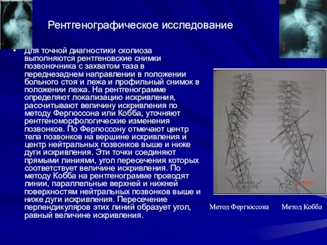 Рентгенографическое исследование Для точной диагностики сколиоза выполняются рентгеновские снимки позвоночника с