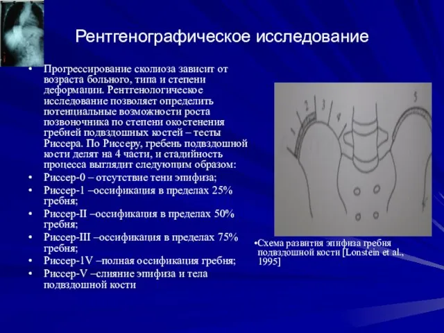 Рентгенографическое исследование Прогрессирование сколиоза зависит от возраста больного, типа и степени