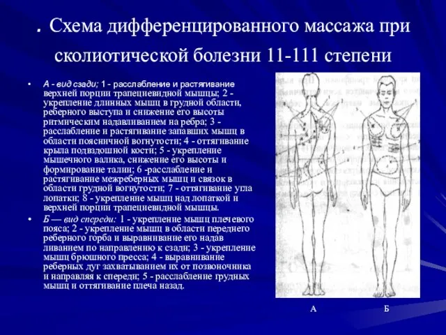 . Схема дифференцированного массажа при сколиотической болезни 11-111 степени А -