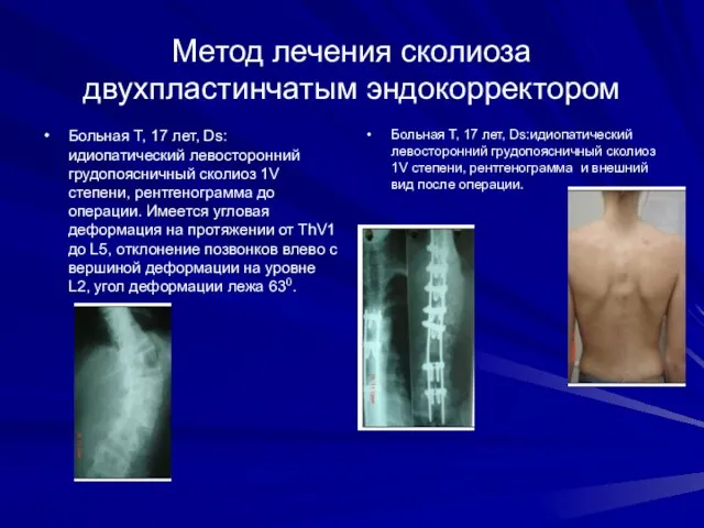 Метод лечения сколиоза двухпластинчатым эндокорректором Больная Т, 17 лет, Ds: идиопатический