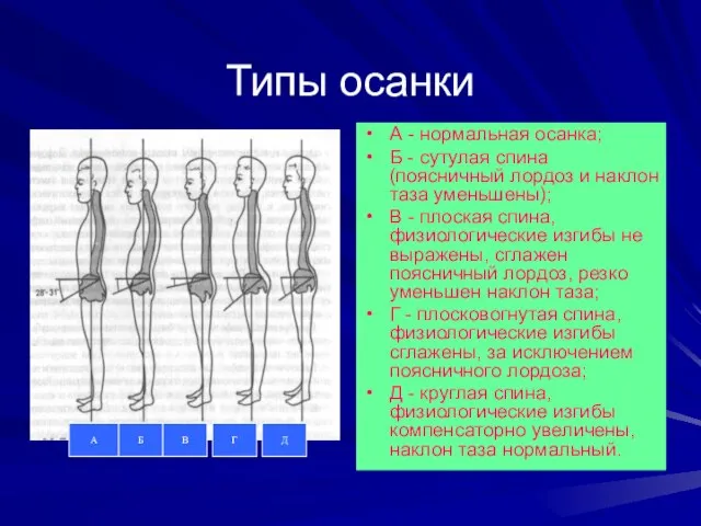 Типы осанки А - нормальная осанка; Б - сутулая спина (поясничный