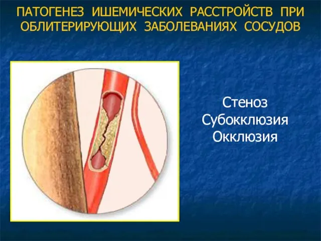 ПАТОГЕНЕЗ ИШЕМИЧЕСКИХ РАССТРОЙСТВ ПРИ ОБЛИТЕРИРУЮЩИХ ЗАБОЛЕВАНИЯХ СОСУДОВ Стеноз Субокклюзия Окклюзия