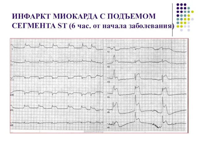 ИНФАРКТ МИОКАРДА С ПОДЪЕМОМ СЕГМЕНТА ST (6 час. от начала заболевания)