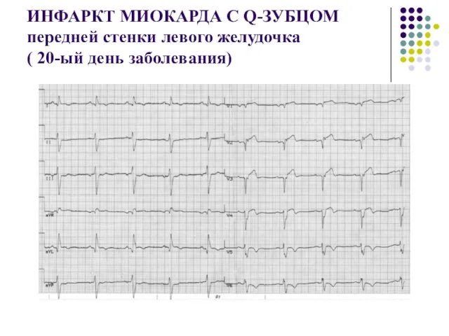 ИНФАРКТ МИОКАРДА С Q-ЗУБЦОМ передней стенки левого желудочка ( 20-ый день заболевания)