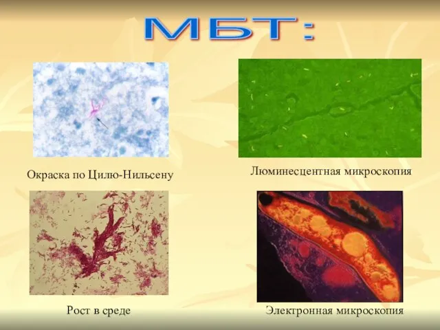 МБТ: Окраска по Цилю-Нильсену Люминесцентная микроскопия Рост в среде Электронная микроскопия