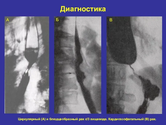 Диагностика А Б В Циркулярный (А) и блюдцеобразный рак с/3 пищевода. Кардиоэзофагальный (В) рак.