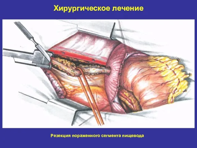 Хирургическое лечение Резекция пораженного сегмента пищевода