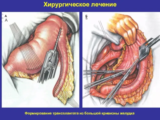 Хирургическое лечение А А Б Б Формирование трансплантата из большой кривизны желудка