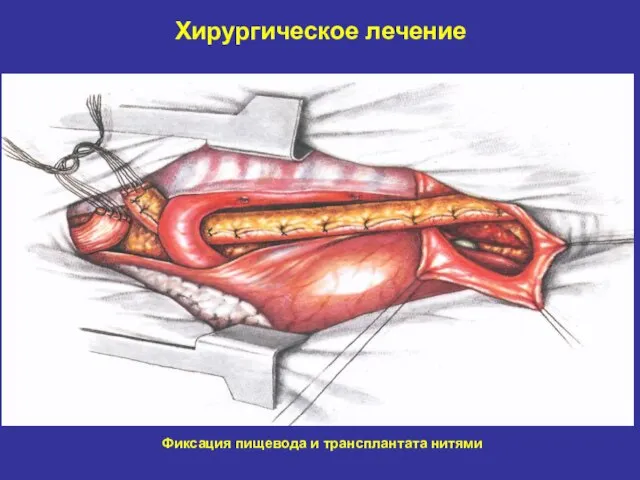 Хирургическое лечение Фиксация пищевода и трансплантата нитями