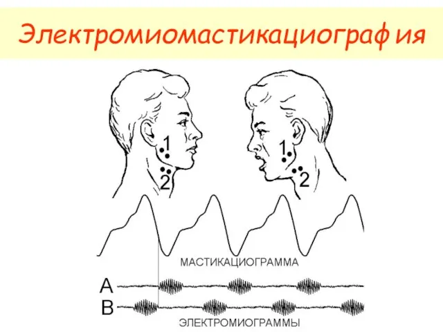 Электромиомастикациография