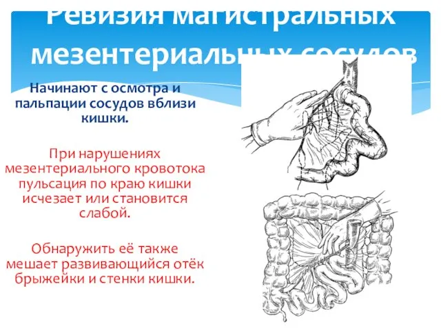 Ревизия магистральных мезентериальных сосудов Начинают с осмотра и пальпации сосудов вблизи