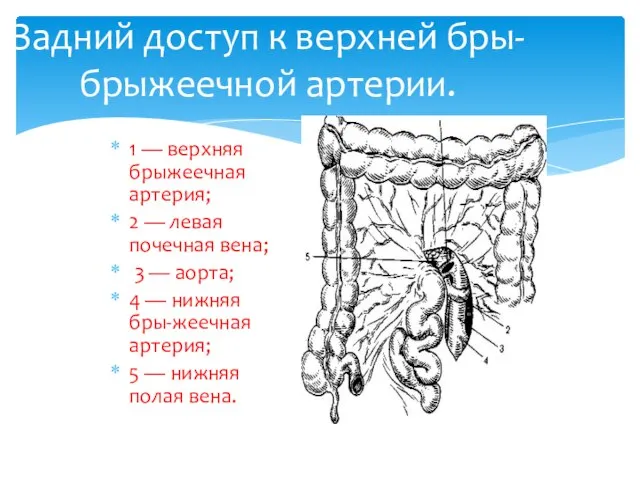 Задний доступ к верхней бры- брыжеечной артерии. 1 — верхняя брыжеечная