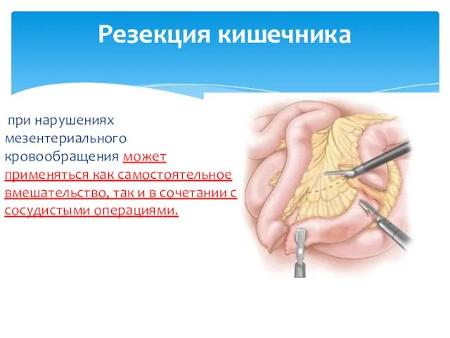 Резекция кишечника при нарушениях мезентериального кровообращения может применяться как самостоятельное вмешательство,