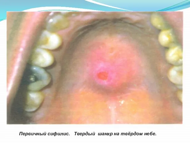 поверхности Первичный сифилис. Твердый шанкр на твёрдом небе.