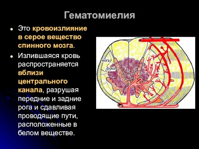 Гематомиелия Это кровоизлияние в серое вещество спинного мозга. Излившаяся кровь распространяется