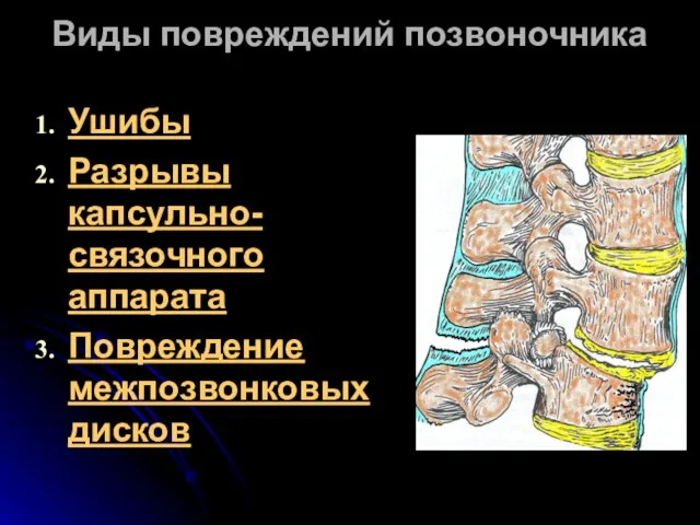 Виды повреждений позвоночника Ушибы Разрывы капсульно-связочного аппарата Повреждение межпозвонковых дисков