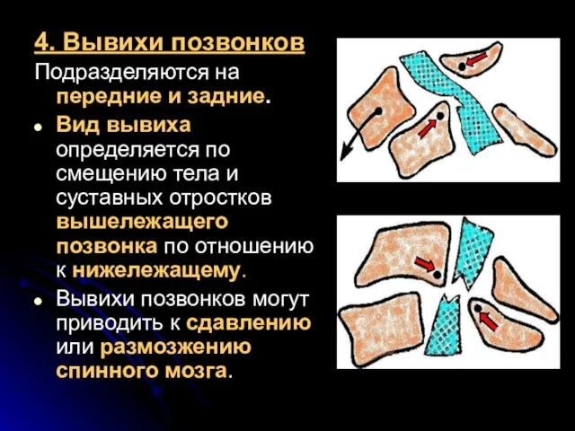 4. Вывихи позвонков Подразделяются на передние и задние. Вид вывиха определяется