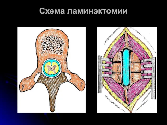 Схема ламинэктомии