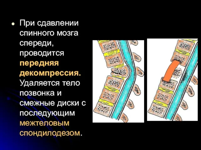 При сдавлении спинного мозга спереди, проводится передняя декомпрессия. Удаляется тело позвонка