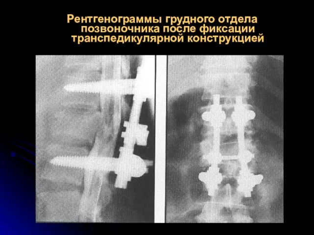Рентгенограммы грудного отдела позвоночника после фиксации транспедикулярной конструкцией
