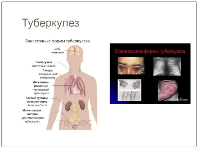 Туберкулез