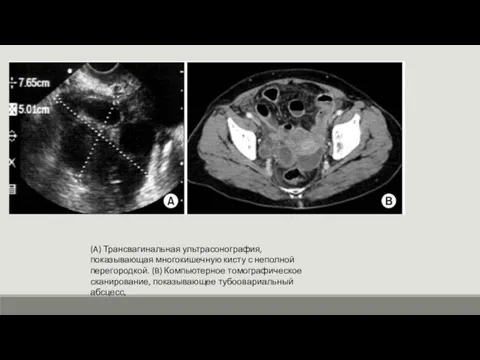 (A) Трансвагинальная ультрасонография, показывающая многокишечную кисту с неполной перегородкой. (B) Компьютерное томографическое сканирование, показывающее тубоовариальный абсцесс,