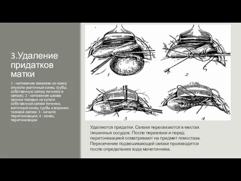 3.Удаление придатков матки 1 - наложение зажимов на ножку опухоли (маточный