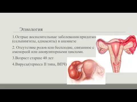 Этиология 1.Острые воспалительные заболевания придатков (сальпингиты, аднекситы) в анамнезе 2. Отсутствие