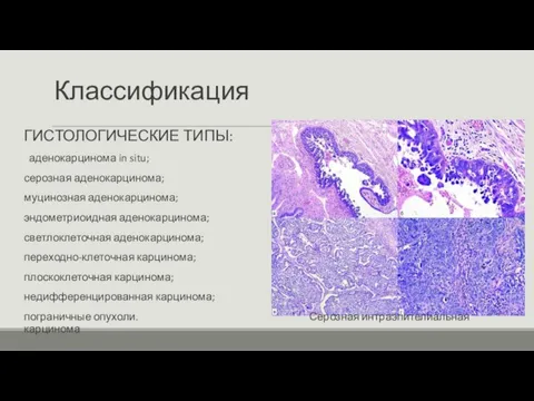 Классификация ГИСТОЛОГИЧЕСКИЕ ТИПЫ: аденокарцинома in situ; серозная аденокарцинома; муцинозная аденокарцинома; эндометриоидная