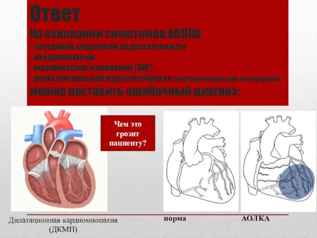Ответ На основании симптомов АОЛКА - застойной сердечной недостаточности - кардиомегалии