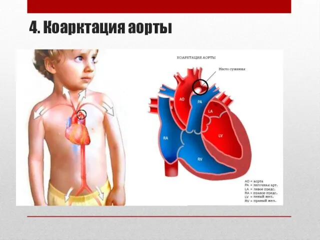 4. Коарктация аорты