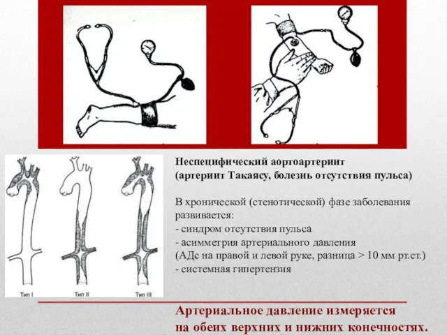 Неспецифический аортоартериит (артериит Такаясу, болезнь отсутствия пульса) В хронической (стенотической) фазе