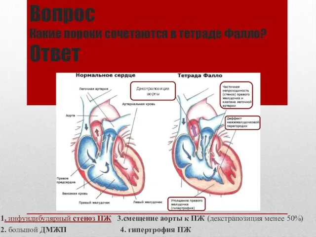 Вопрос Какие пороки сочетаются в тетраде Фалло? Ответ 1. инфундибулярный стеноз